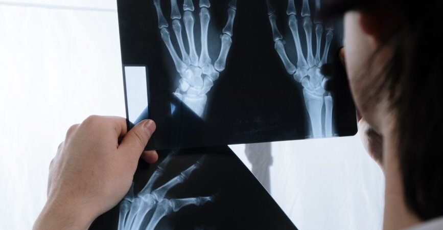 Scaphoid Fracture: Why This Wrist Break Gets Missed