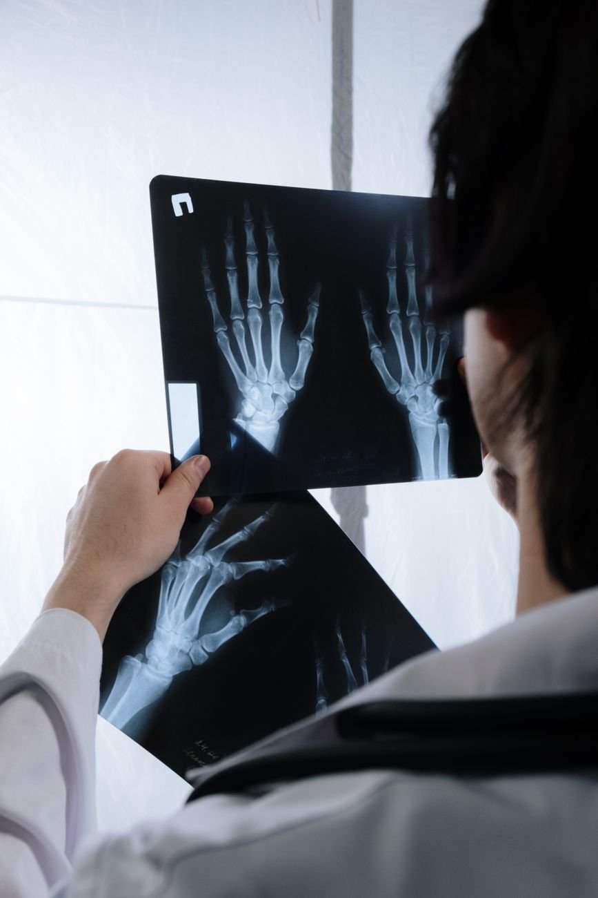 Scaphoid Fracture: Why This Wrist Break Gets Missed