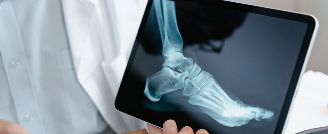 Medial Ankle Sprain: A Complete Guide
