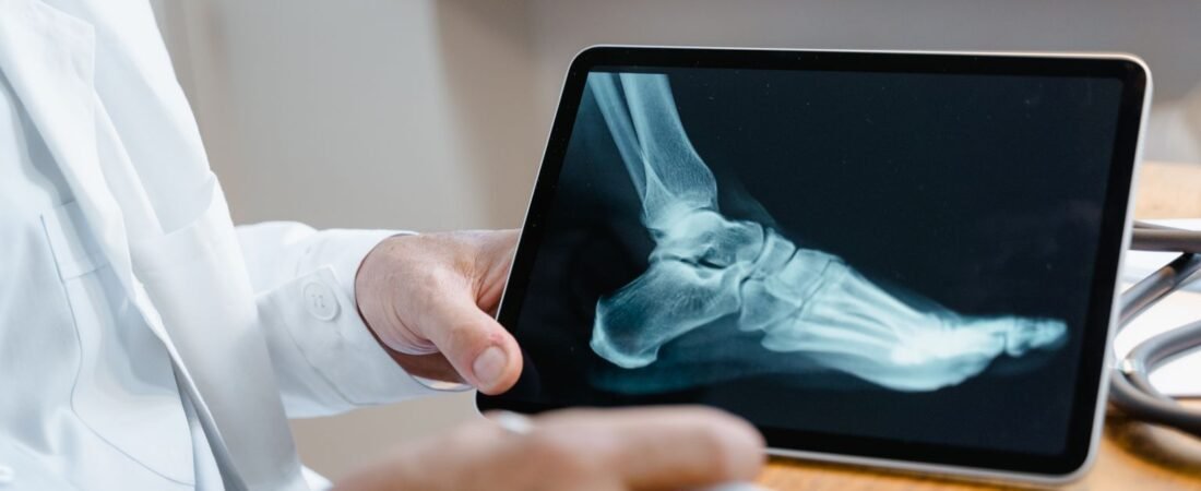 Jones Fracture Treatment: Explained Simply