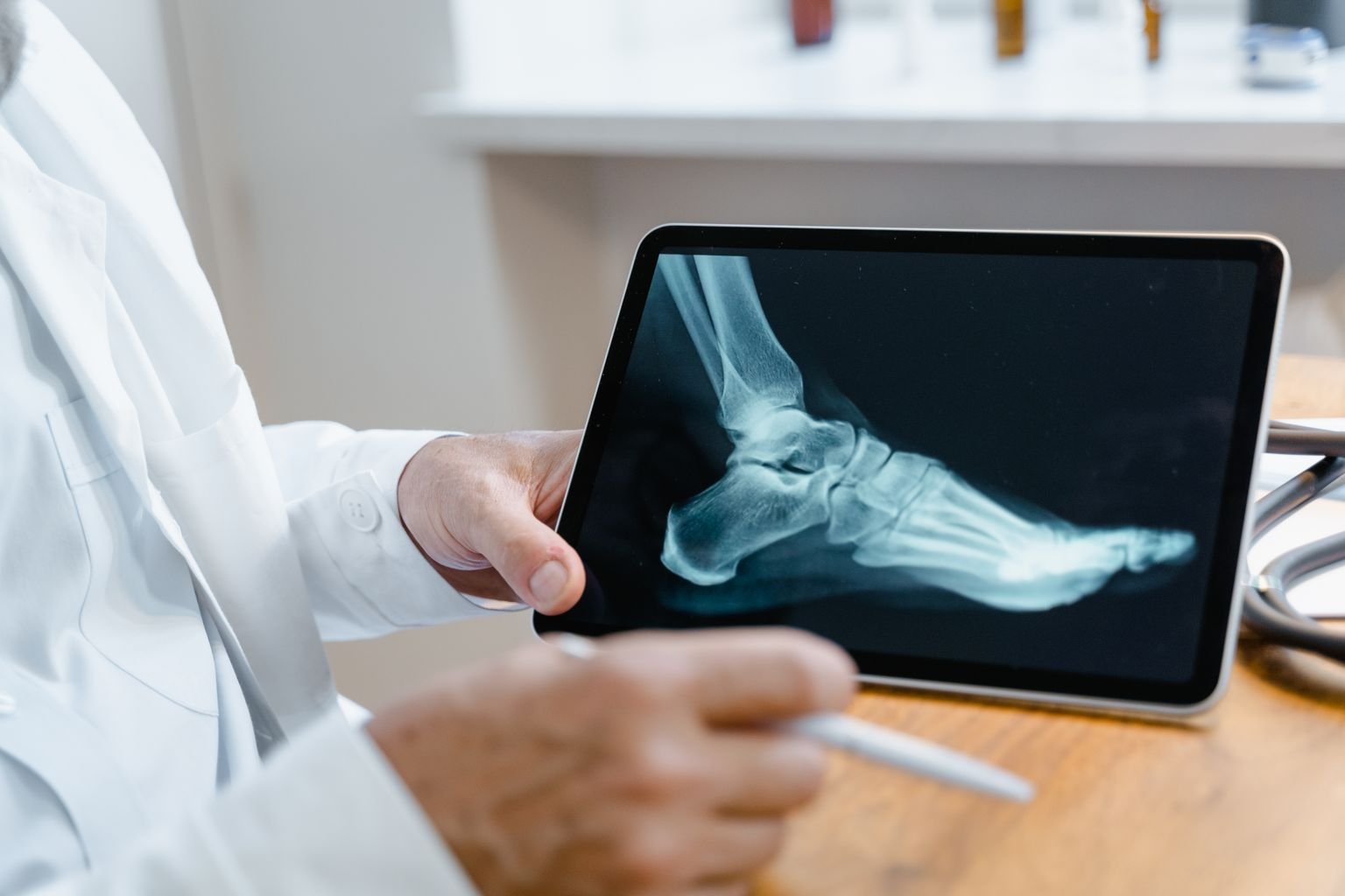 Jones Fracture Treatment: Explained Simply