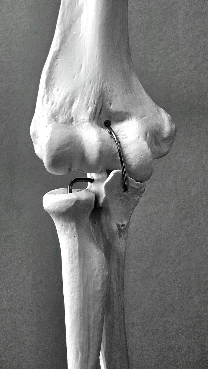 A physiotherapist assessing knee stability to determine which MCL exercises to avoid at this stage of recovery.
