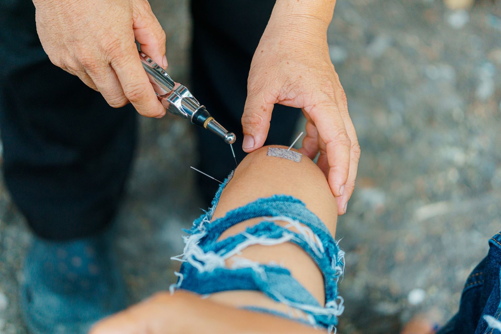 Close-up of acupuncture treatment on a knee, a common site examined when asking does acupuncture work for sports injuries