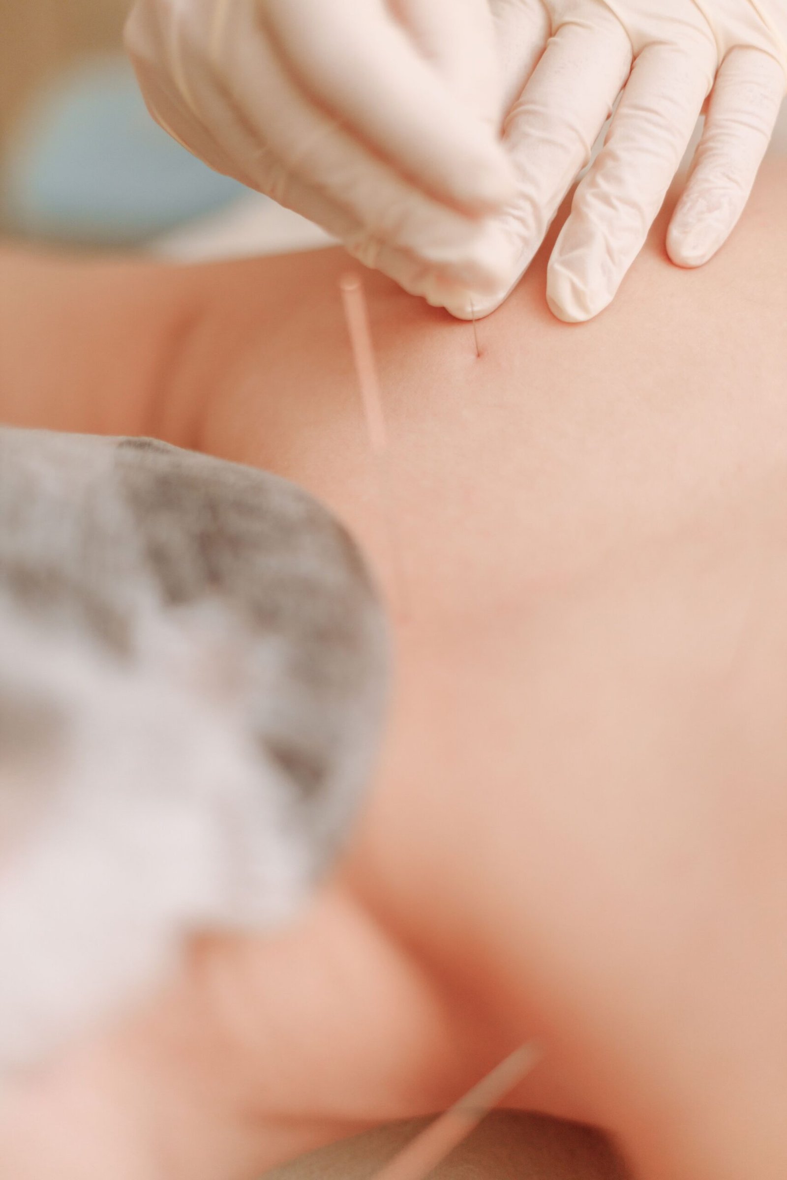 Acupuncture For Sciatica: A Complete Guide