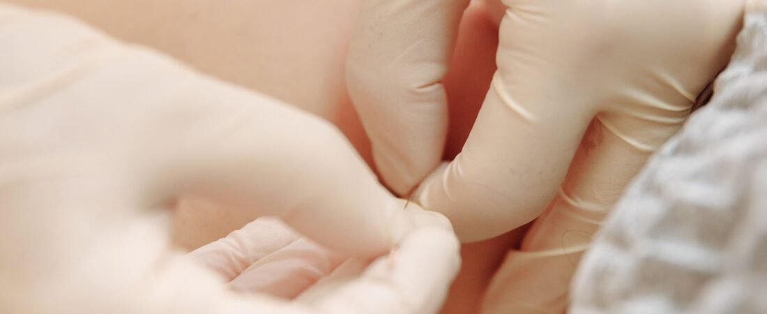 Acupuncture Vs Dry Needling: Which One Actually Works Better?