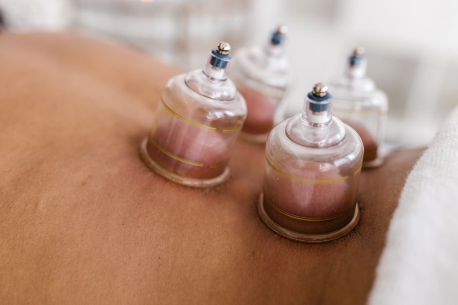 Cupping therapy marks visible on skin shortly after a session, before and after cupping therapy