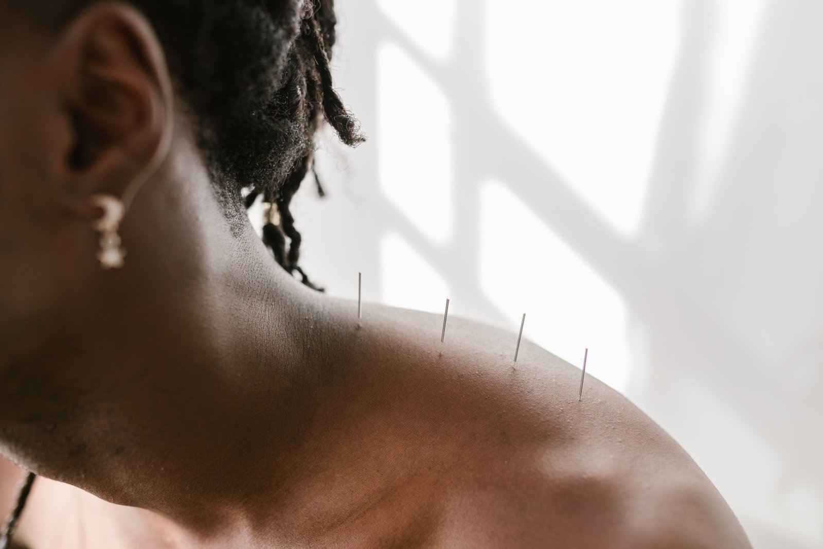 Needles applied to the shoulder, illustrating acupuncture vs dry needling in practice