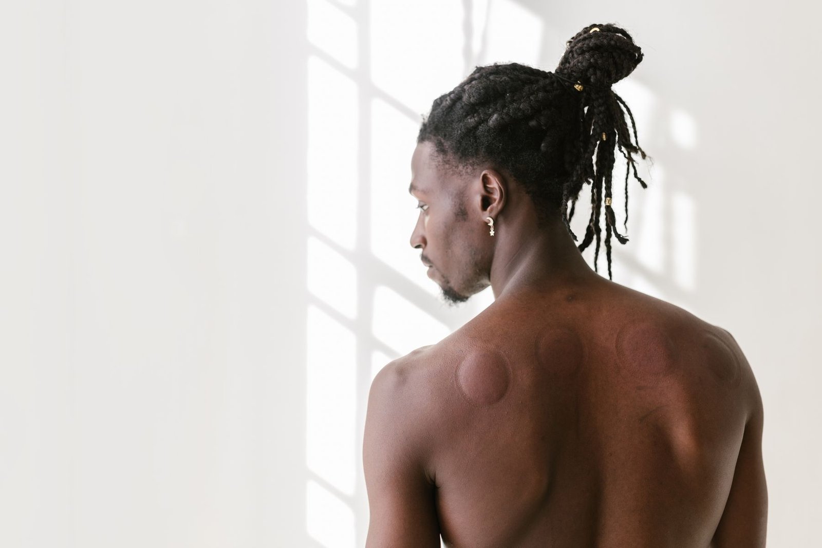 Cupping therapy marks visible on a client's back, illustrating the purpose of cupping as a recovery tool