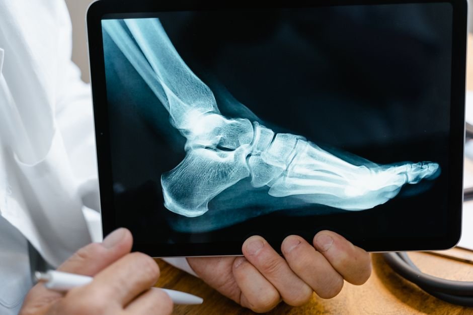 Doctor reviewing an ankle X-ray to properly assess high ankle sprain pictures against a real diagnosis